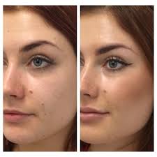 1 ml cheek filler before and after